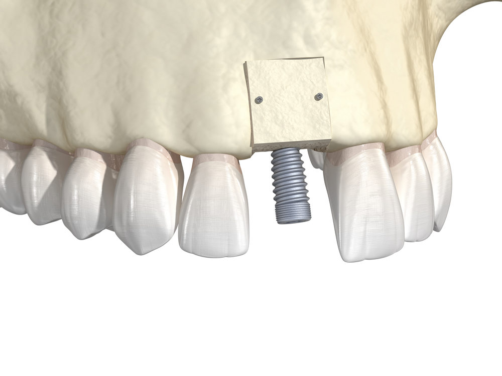 Bone,Grafting-,Augmentation,Using,Block,Of,Bone,,Tooth,Implantation.,Medically