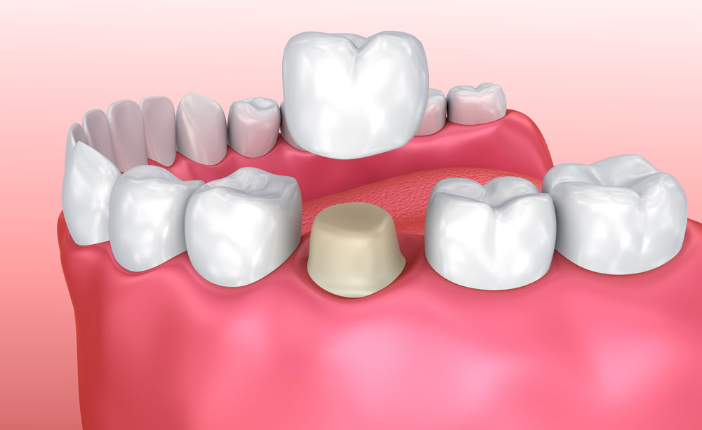 Dental,Crown,Installation,Process,,Medically,Accurate,3d,Illustration