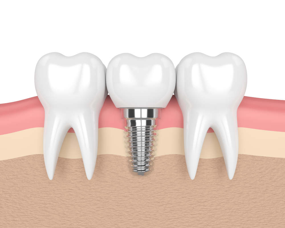 3d,Render,Of,Teeth,With,Dental,Implant,In,Gums,Over