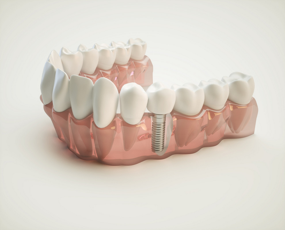 Dental,Implant,-,3d,Rendering