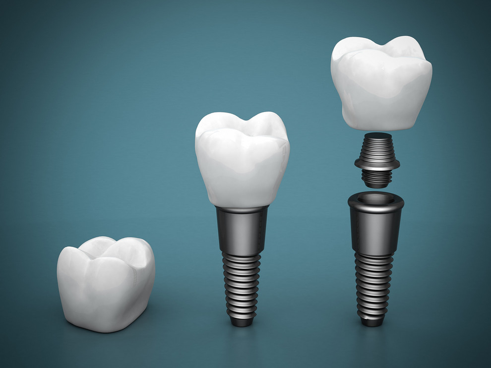 Dental,Implants,On,A,Beautiful,Blue,Background