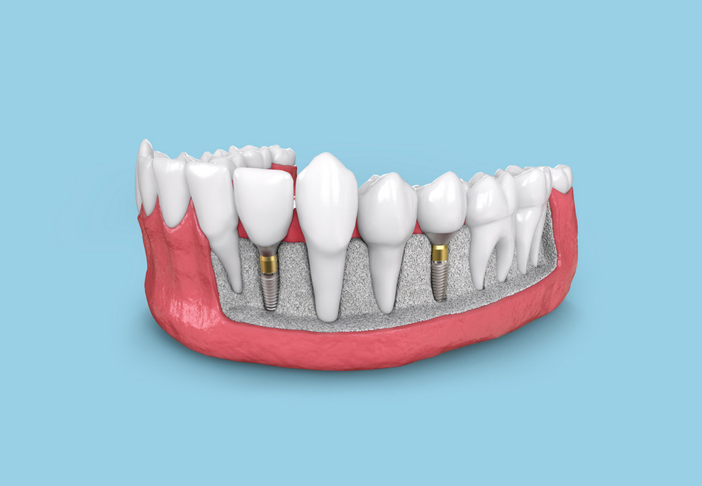 Tooth,Implant,Model,In,Jaw,3d,Illustration