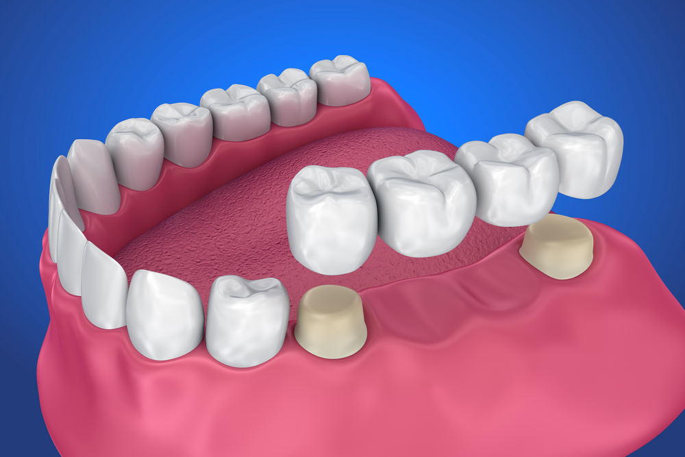 Tooth,Supported,Fixed,Bridge.,Medically,Accurate,3d,Illustration