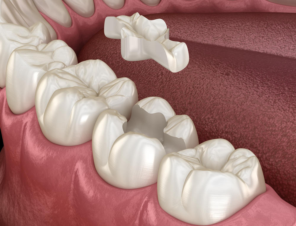 Inlay,Ceramic,Crown,Fixation,Over,Tooth.,Medically,Accurate,3d,Illustration