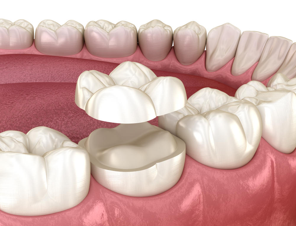 Onlay,Ceramic,Crown,Fixation,Over,Molar,Tooth.,Medically,Accurate,3d