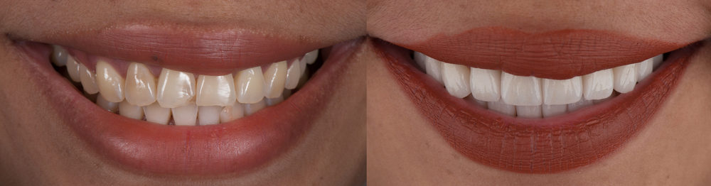 Full,Mouth,Smile,Makeover,With,Dental,Ceramic,Veneers,Treatment,,Present