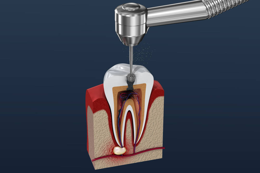 Root,Canal,Treatment,Process.,3d,Illustration