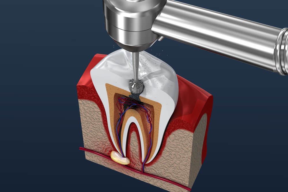 Root,Canal,Treatment,Process.,3d,Illustration