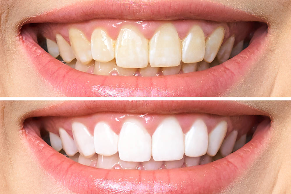 Woman,Teeth,Before,And,After,Whitening.,Over,White,Background.,Dental