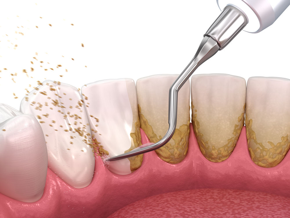 Oral,Hygiene:,Scaling,And,Root,Planing,(conventional,Periodontal,Therapy).,Medically