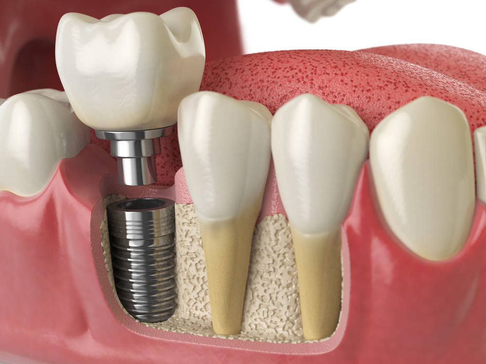 Anatomy,Of,Healthy,Teeth,And,Tooth,Dental,Implant,In,Human