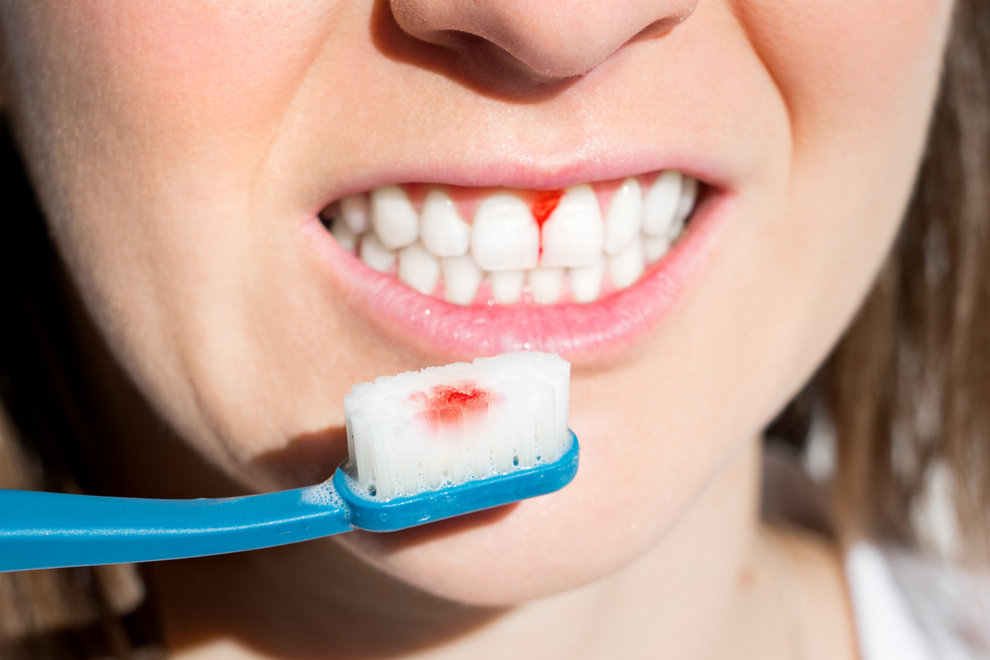 The 5 Common Signs Of Gum Disease California Dental Care