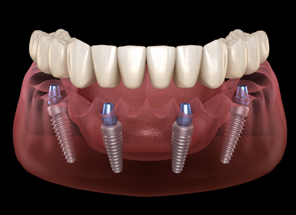 The Benefits of All-On-4® Dental Implants