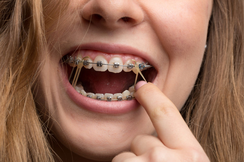 Things to Keep in Mind About Rubber Bands in Braces