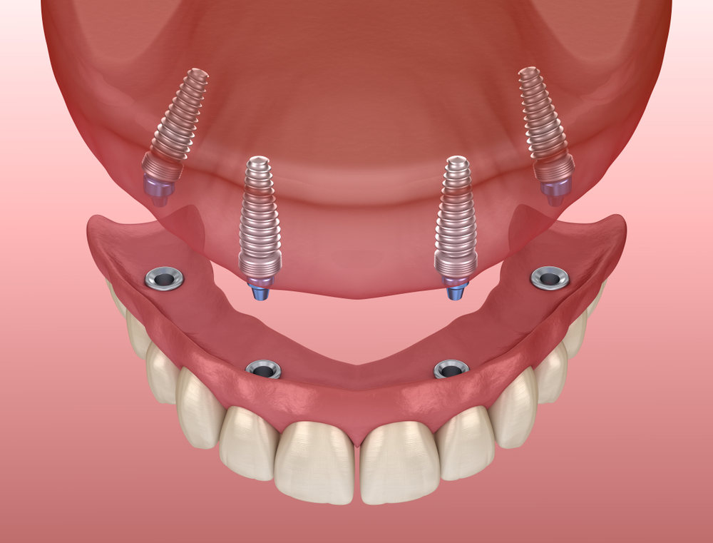 All-On-4 Dental Implants