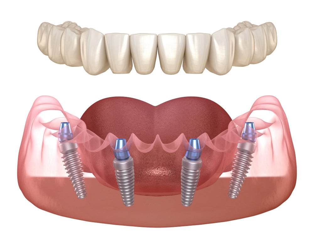 All-On-4 Dental Implants FAQs