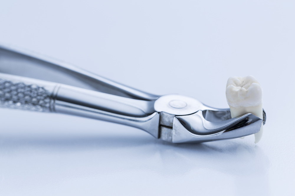Do You Need a Tooth Extraction Learn What to Expect