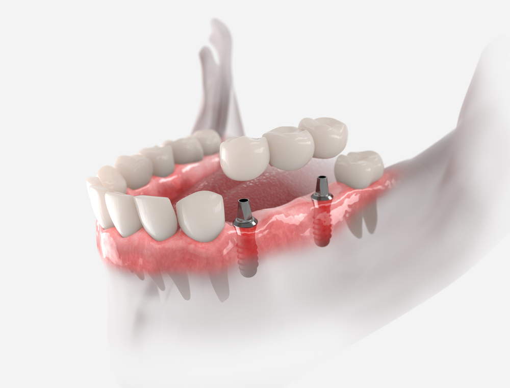 Experienced multiple tooth implant specialists at California Dental Care