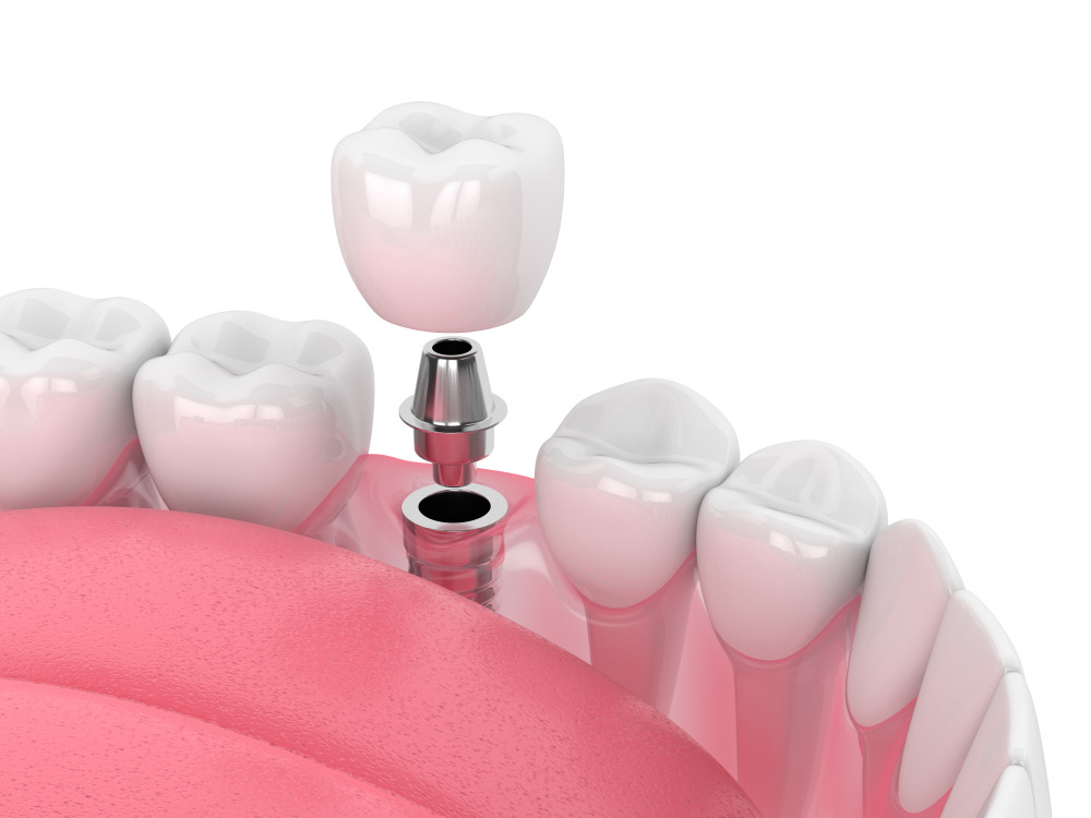 Dental Implant