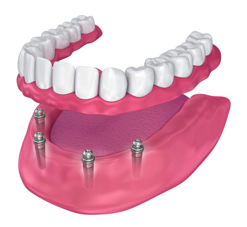 Fixed ImplantSupported Dentures California Dental Care