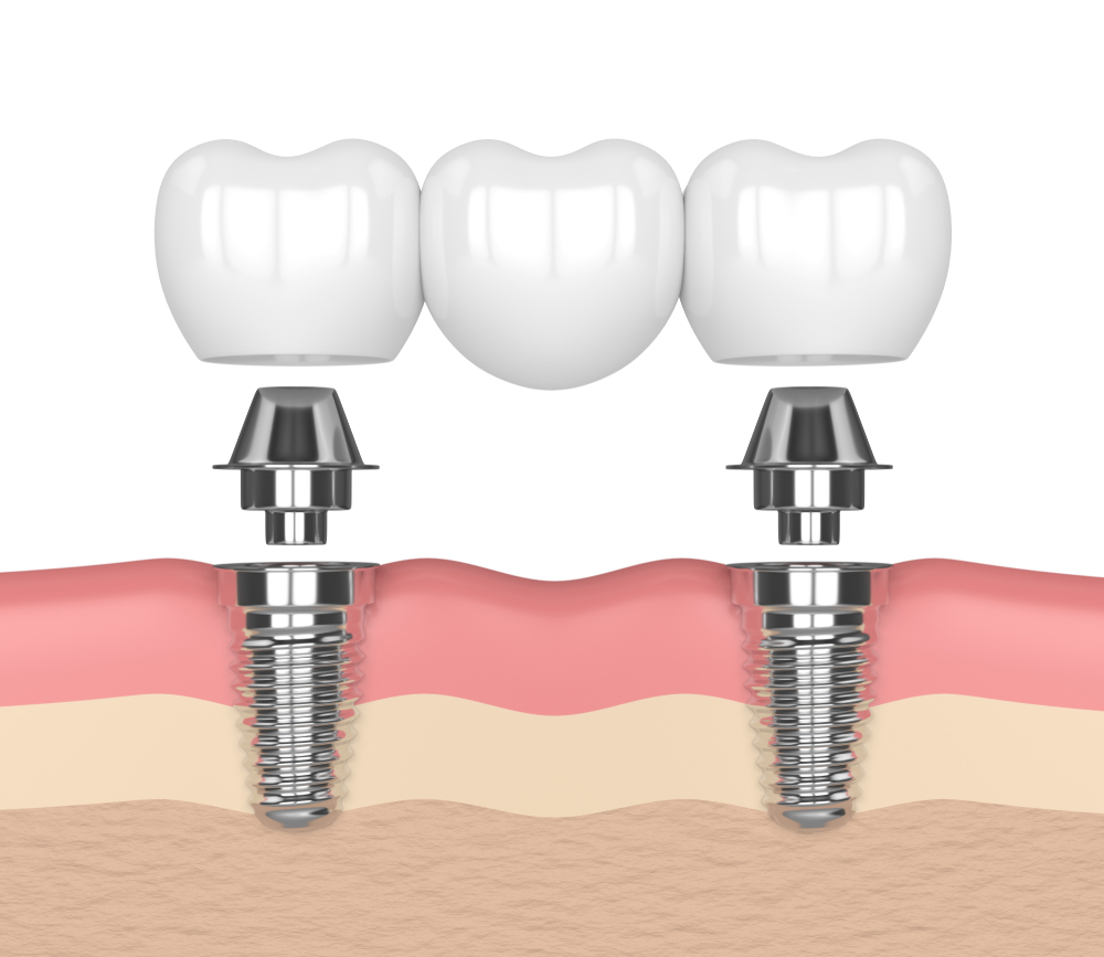 Multiple Dental Implants