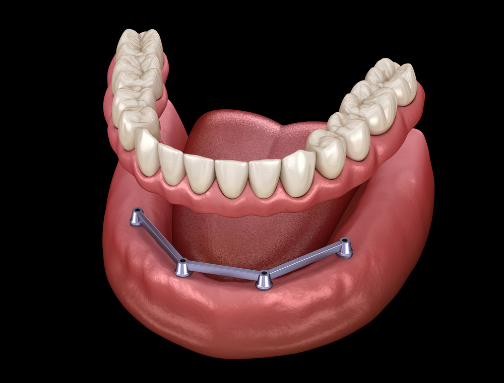 Removable,Mandibular,Prosthesis,With,Gum,All,On,4,System,Supported