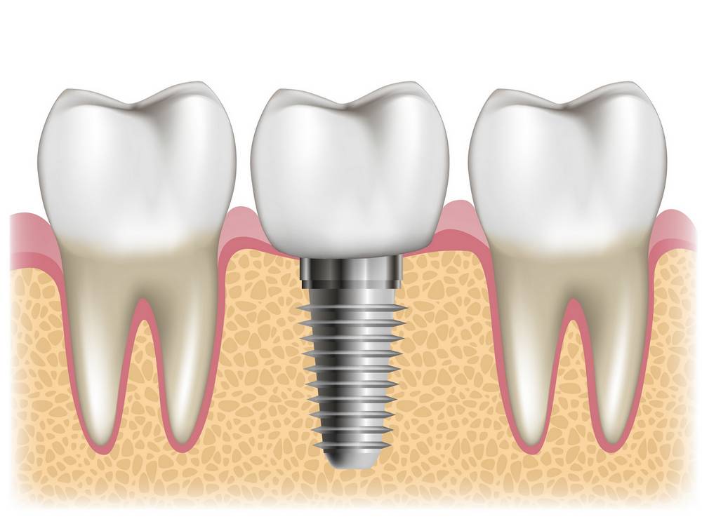 Single Dental Implant