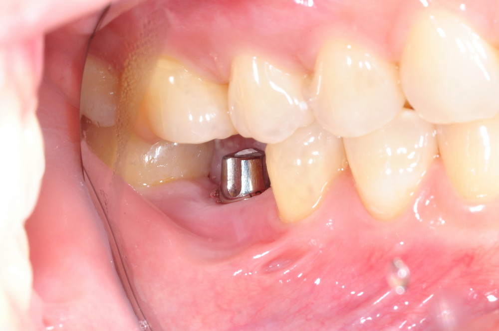 Replacement of a Missing Tooth with a Single Implant