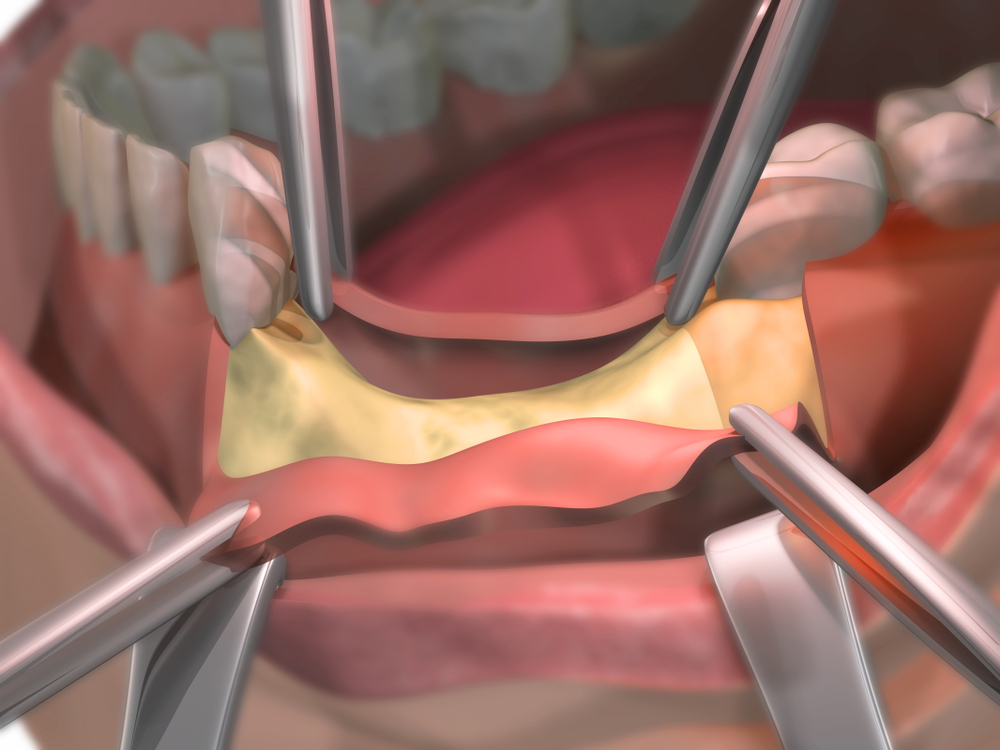 Dental Bone Loss Treatments