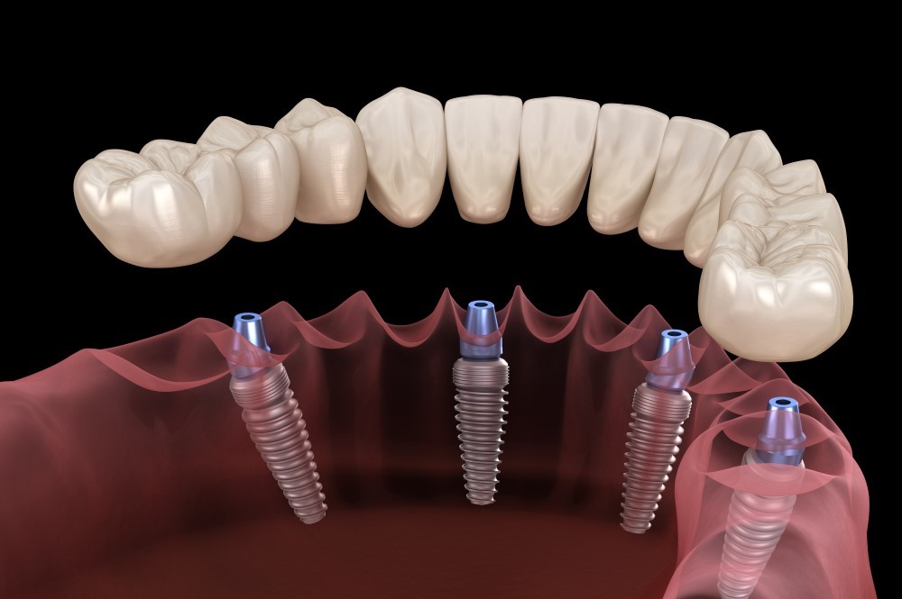 What are All-On-Four Dental Implants