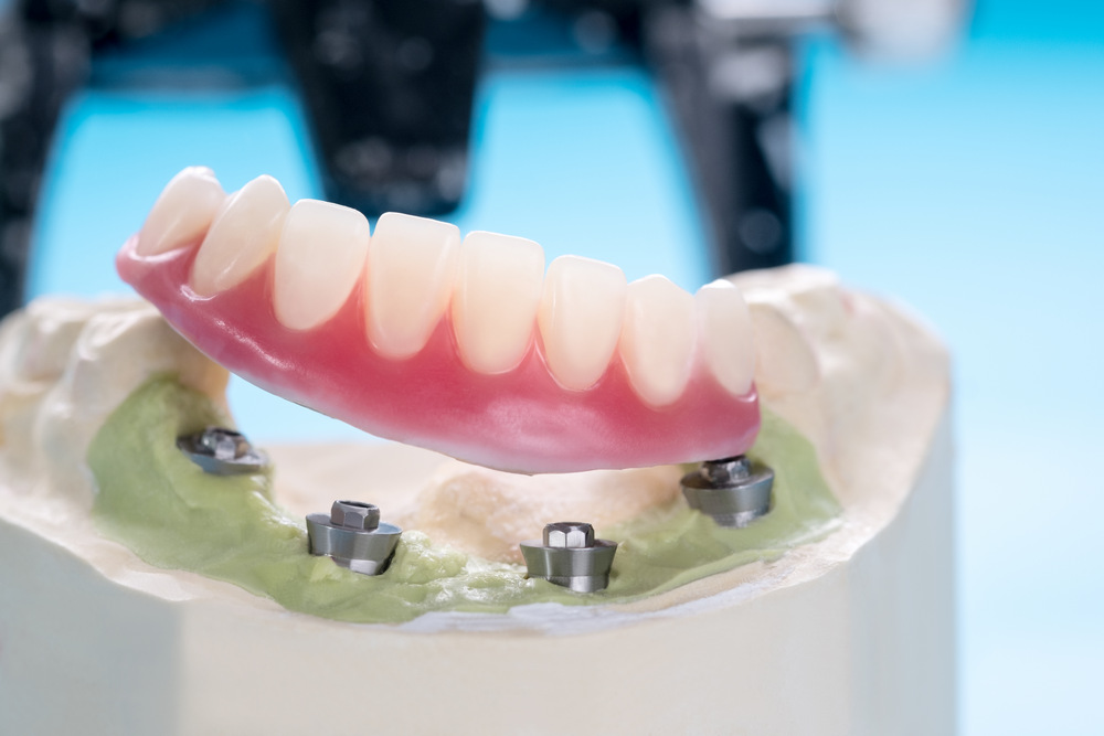 The Advantages of Implant-Supported Dentures