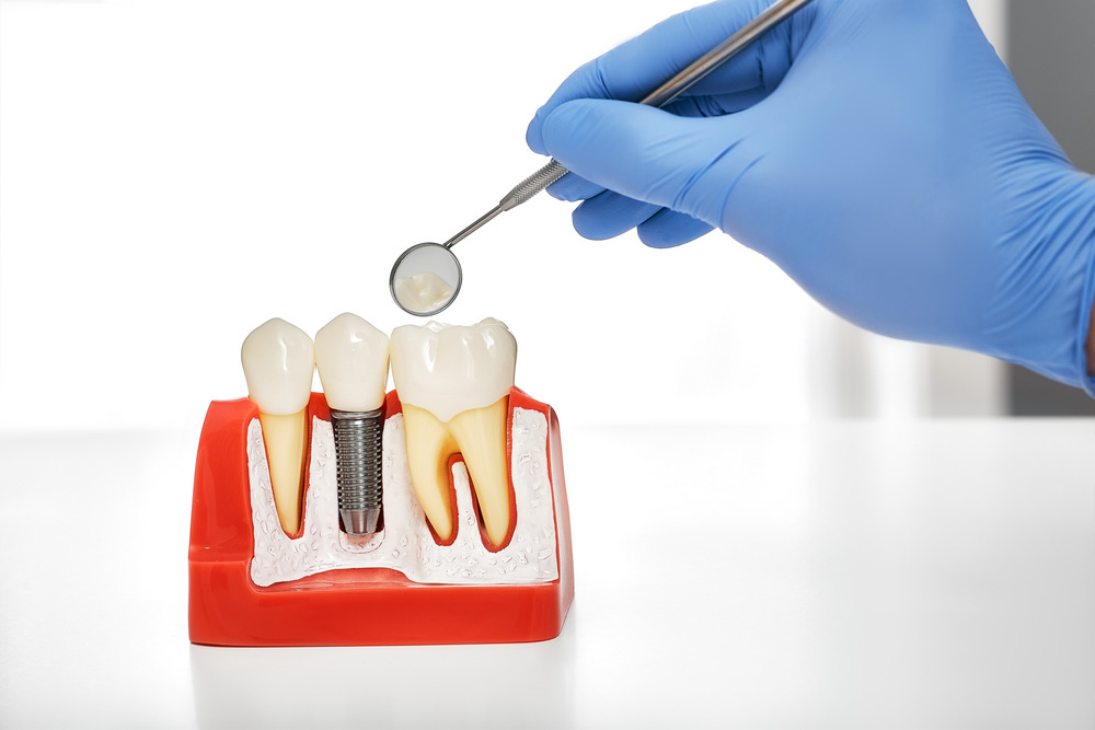 The Benefits of Single-Tooth Dental Implants