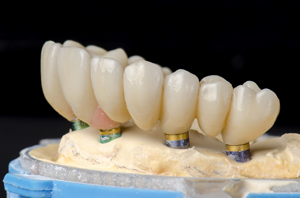 The Top Questions About All-on-4 Dental Implants