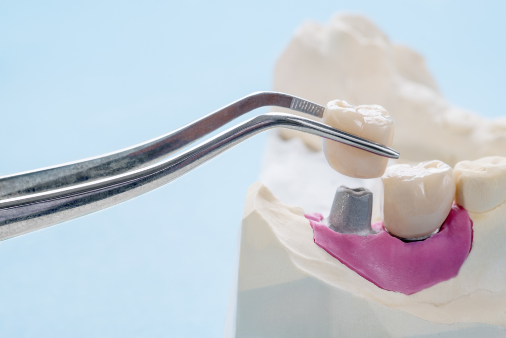 The Top Questions About All-on-4 Dental Implants 