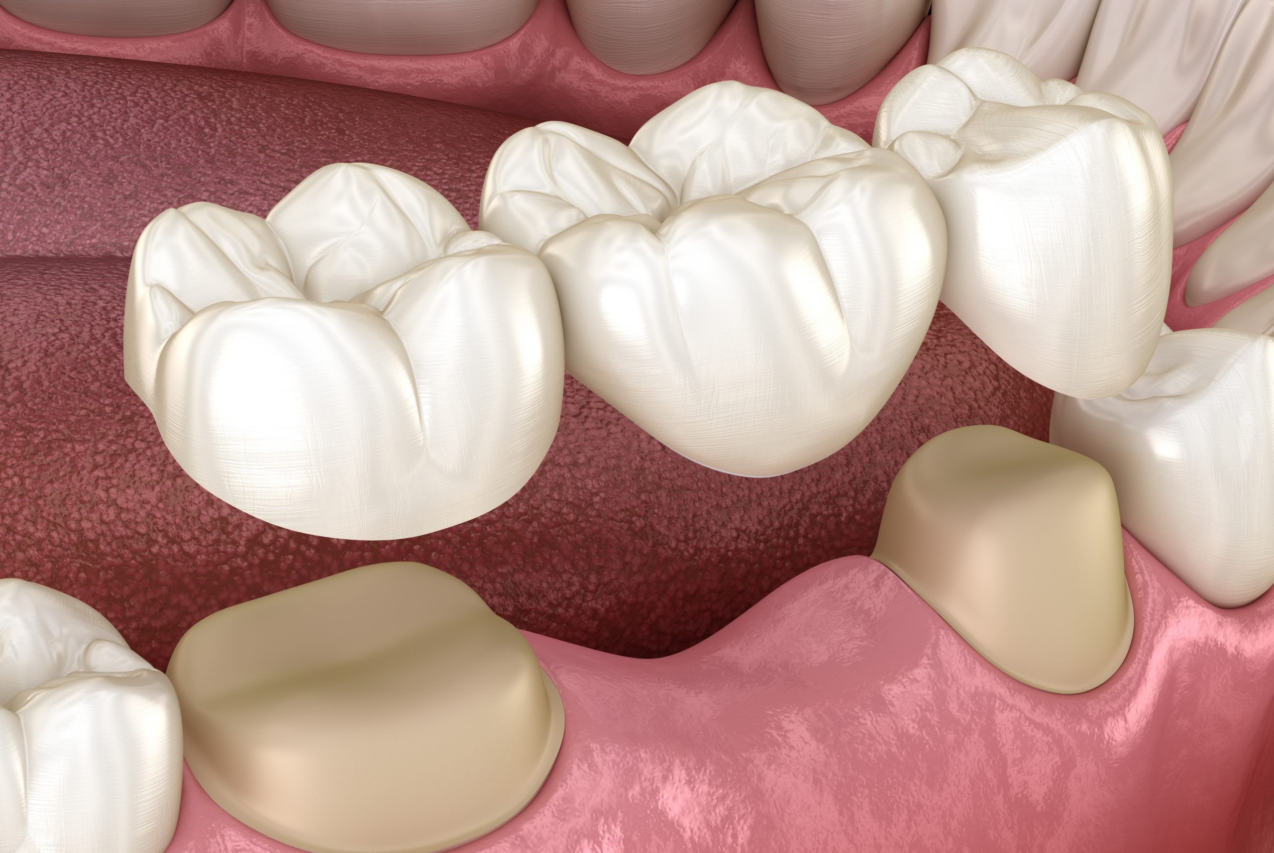 5 Common Questions about Dental Bridges