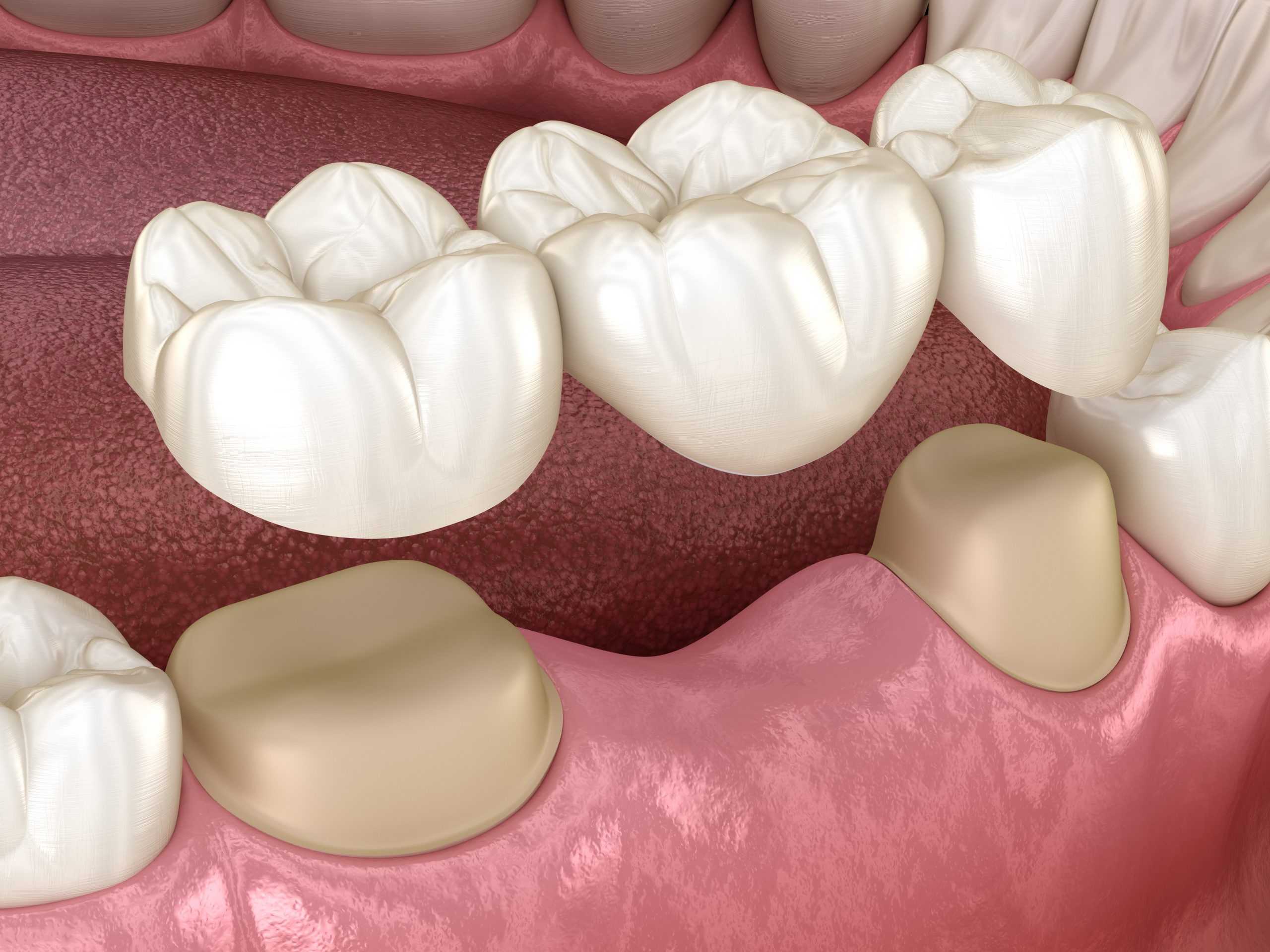 5 Common Questions about Dental Bridges