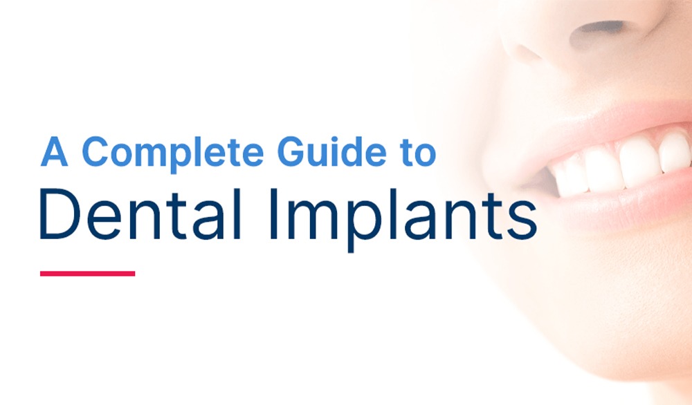 The Ultimate Guide to Dental Implants at California Dental Care in American Canyon