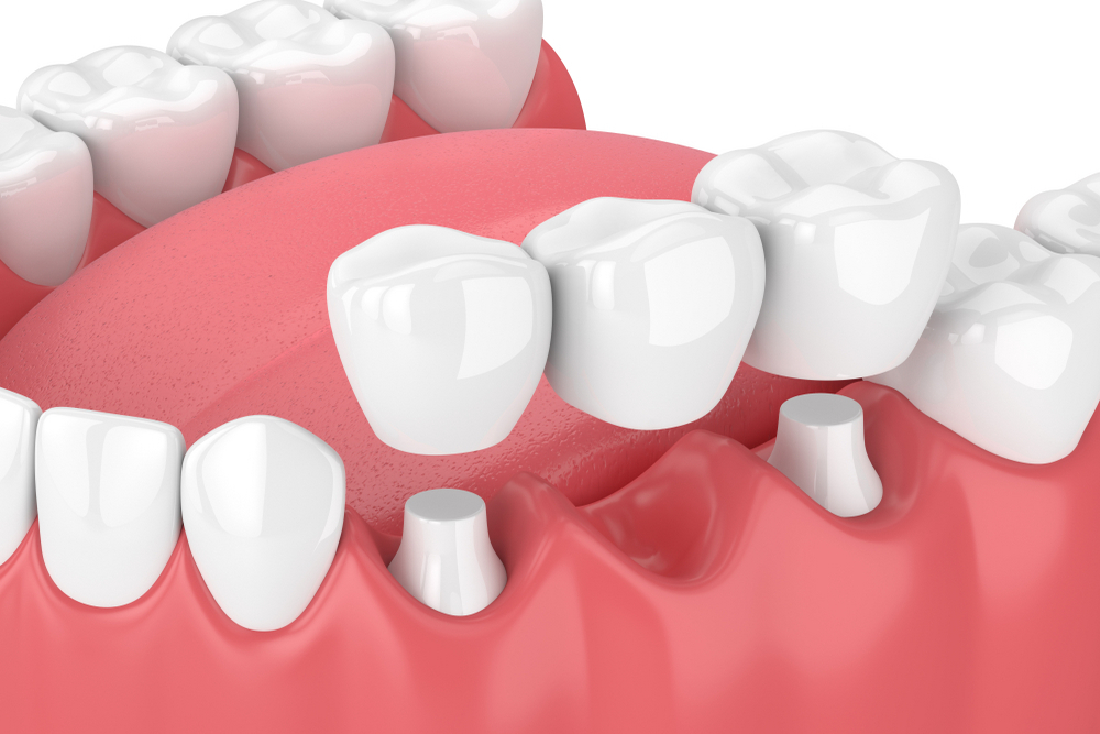 Considering a Dental Bridge